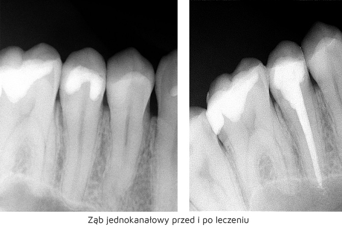 https://stomatolog-krzeszowice.pl/wp-content/uploads/2021/03/zab-jednokanalowy.jpg